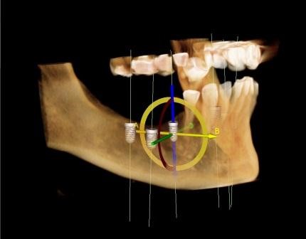 3d guided single implant placement