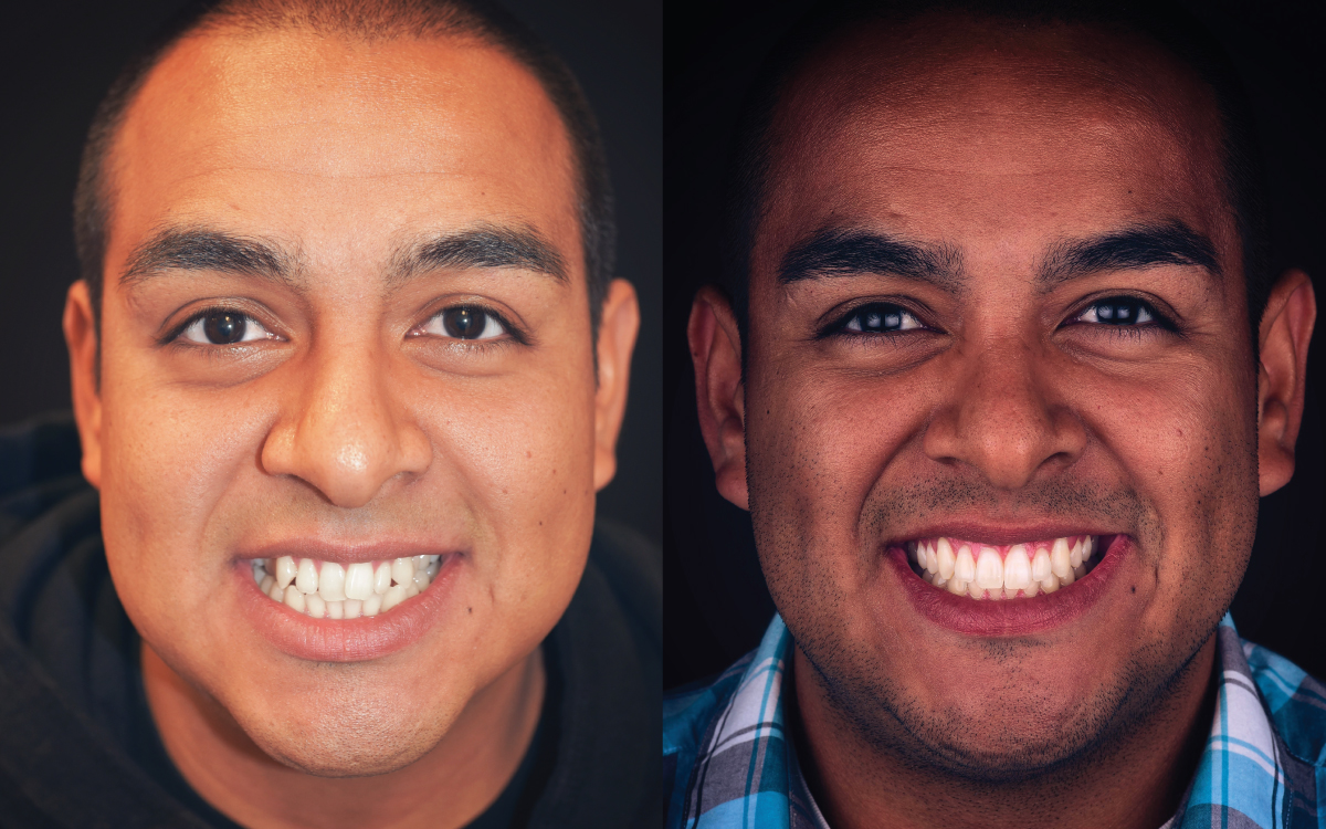 Daniel before and after Six Month Smiles treatment