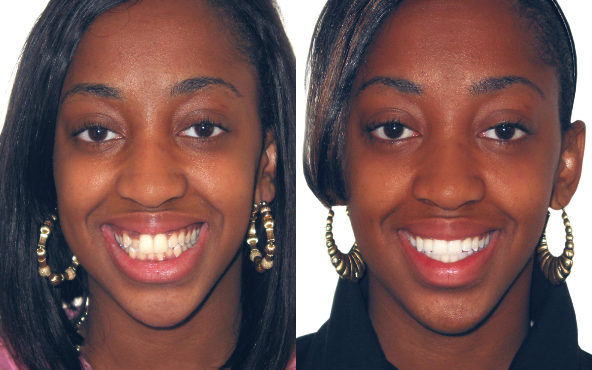 Kayla before and after Six Month Smiles treatment