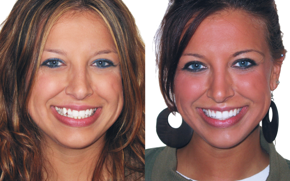 Mellisa before and after Six Month Smiles treatment