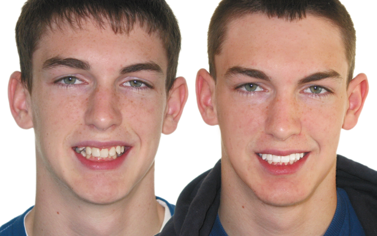 Owen before and after Six Month Smiles treatment