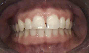 View of mouth/teeth before Invisalign treatment