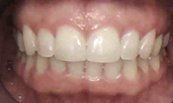 View of mouth/teeth after Invisalign treatment